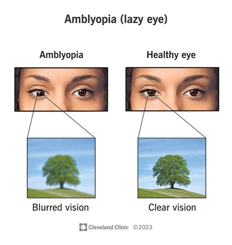 Amblyopia - Syndróm lenivého oka u detí
